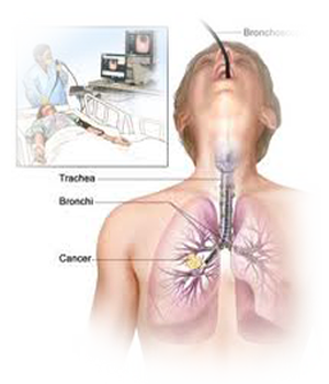Dr.s.z.jafrey indore, Indore chest & allergy Centre, center, Bronchoscopey